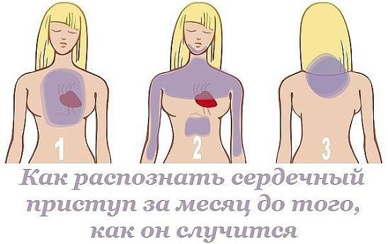 Как распознать сердечный приступ за месяц до того, как он случится Как распознать сердечный приступ за месяц до того, как он случится