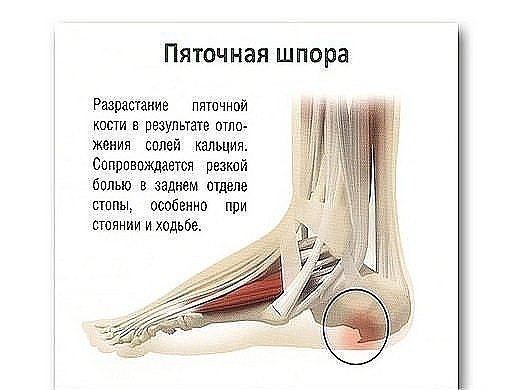 Пяточная шпора: 17 эффективных рецептов народной медицины Пяточная шпора: 17 эффективных рецептов народной медицины